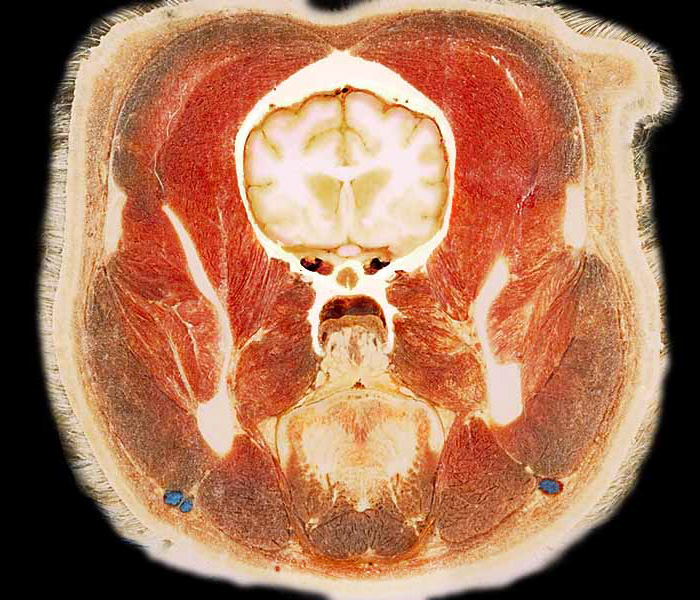 cadaver image